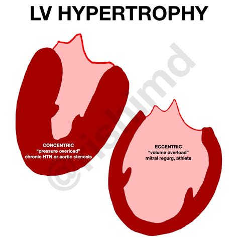 eccentric vs concentric cardiac hypertrophy.